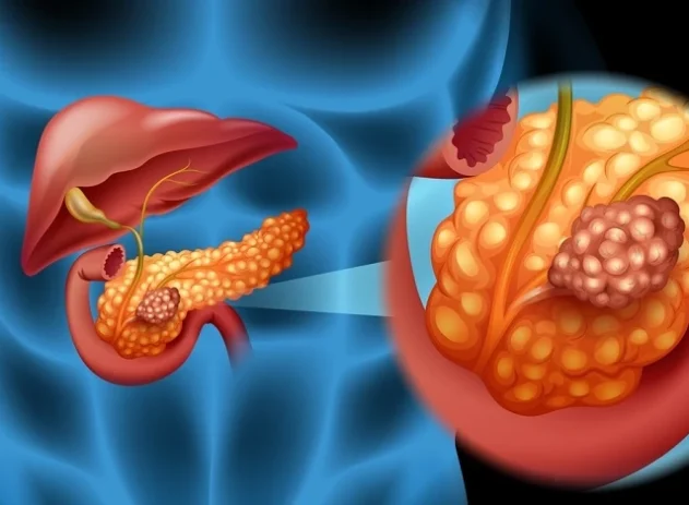 Perspectiva digital sobre a atuação do câncer de pâncreas