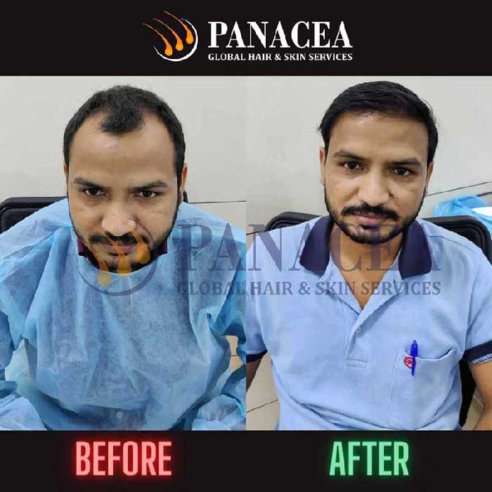 Panacea Global Sets the Standard for Hair Transplants in Delhi