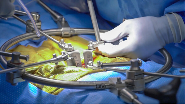Phantom ALTM Anterior Lumbar Access System mula sa TeDan Surgical Innovations