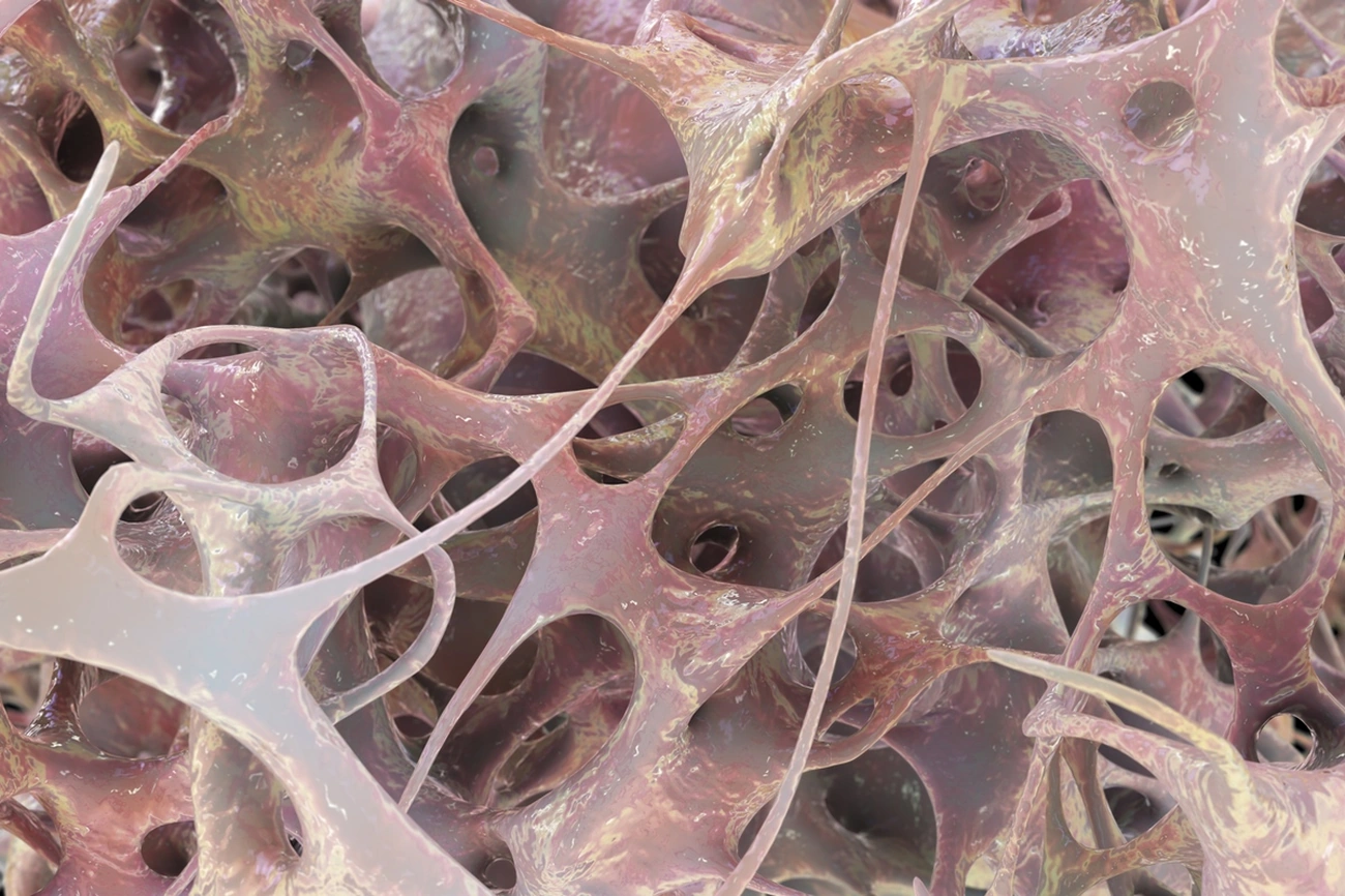 Conheça agora os 3 principais sintomas da osteoporose com um ortopedista