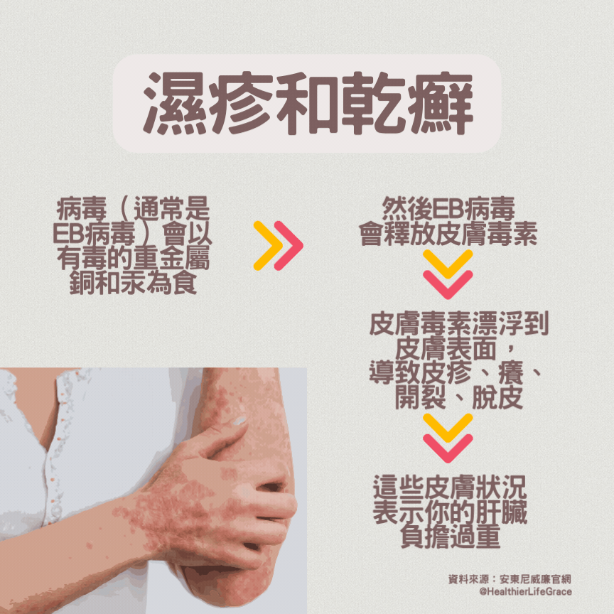 濕疹和乾癬 更健康新風尚