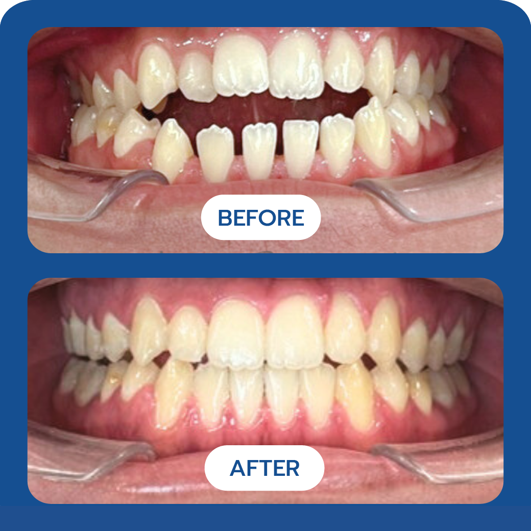 invisalign-before-after