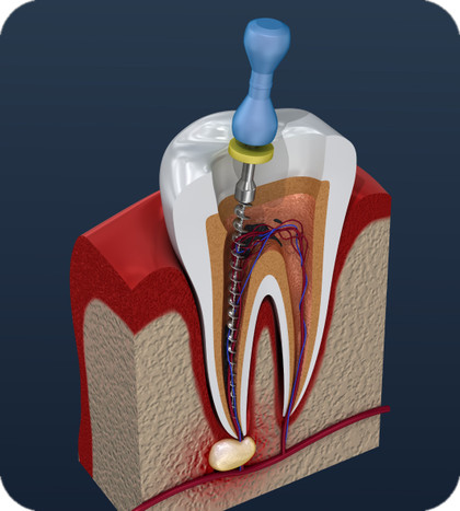 ภาพตัดขวางฟันกรามแสดงโพรงประสาทฟันและคลองรากฟันระหว่างการรักษารากฟัน Dental Wellness Clinic BDMS Wellness Clinic