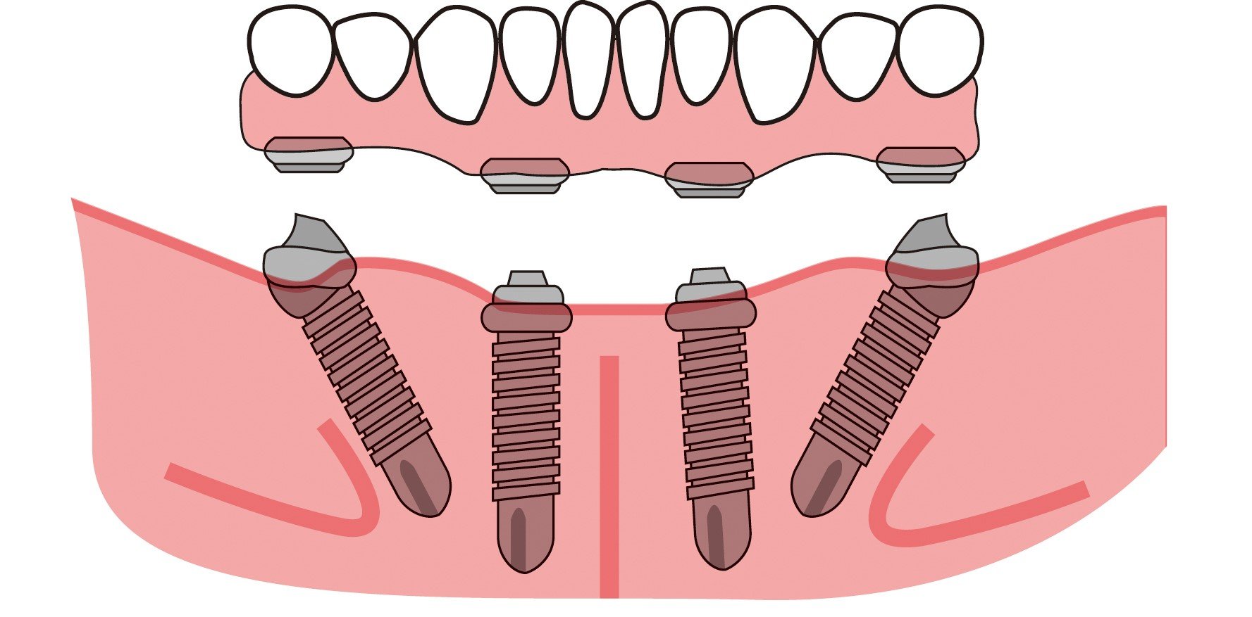 All-on-four dental implants in Thailand