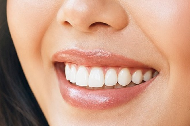 รอยยิ้มฟันขาวเรียงสวยสม่ำเสมอ สื่อถึงผลลัพธ์ของการทำวีเนียร์