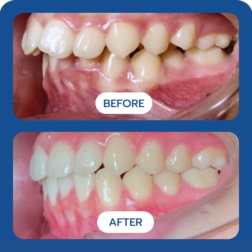 Before After invisalign 2