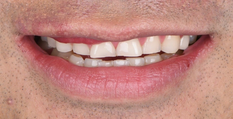 Case 22 before