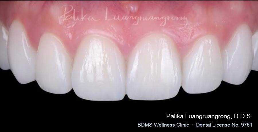 Case 26 after