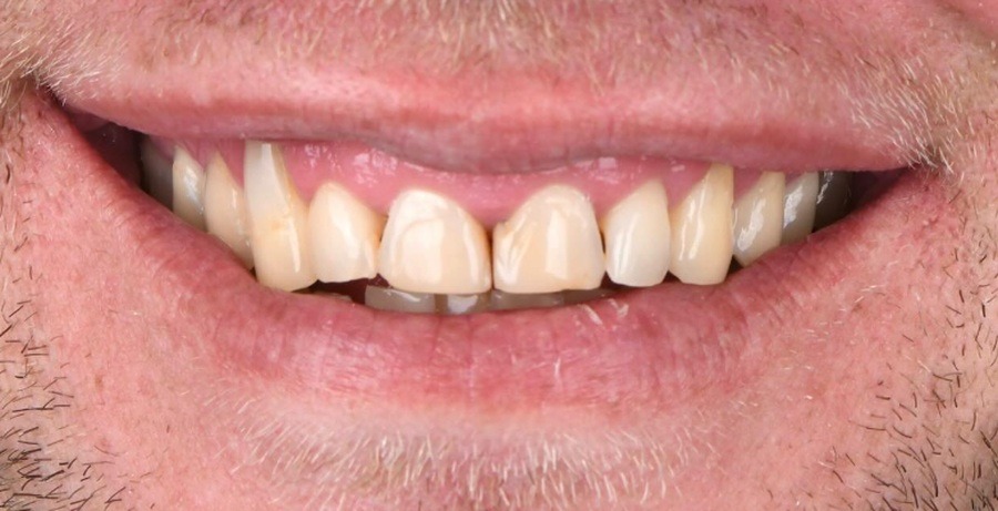 Case 33 before