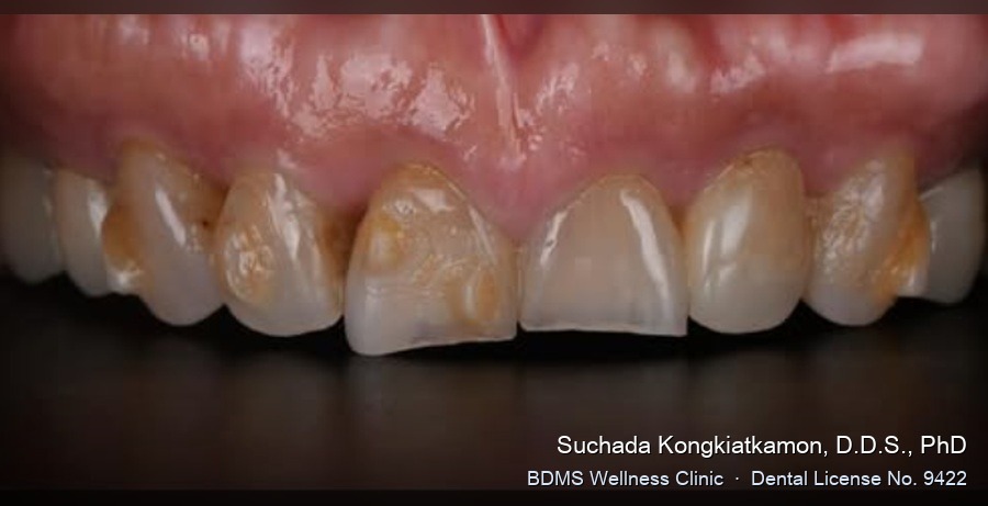 Case 20 before
