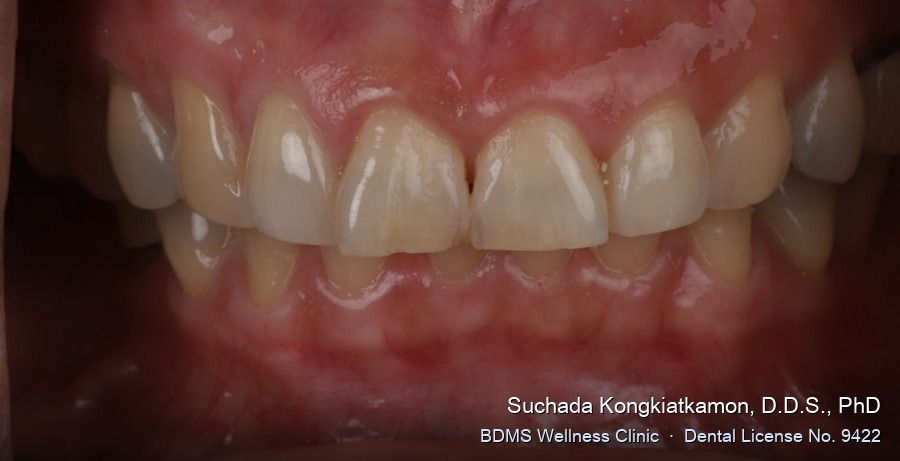 Case 16 before