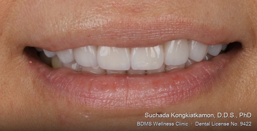 Case 04 after