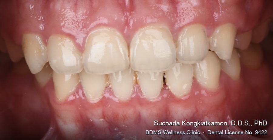 Case 19 before