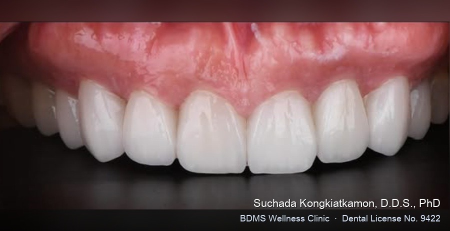 Case 20 after