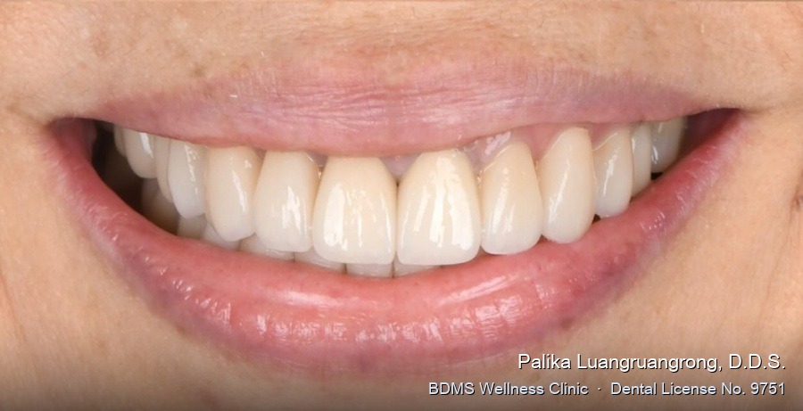 Case 02 after