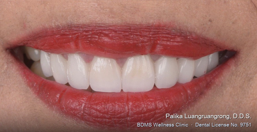 Case 23 after