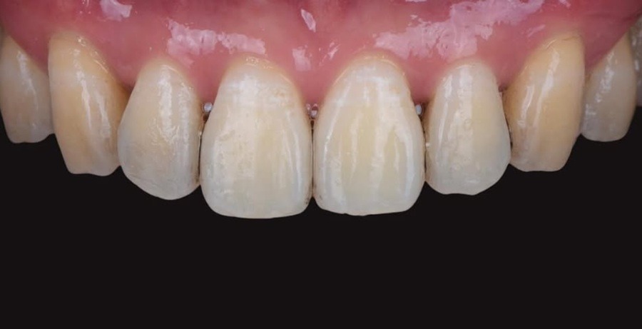 Case 37 before