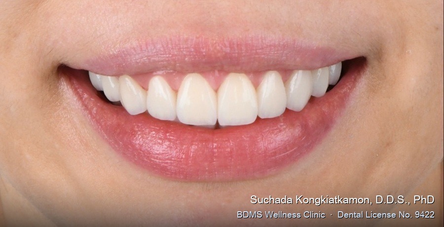 Case 06 after