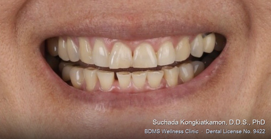 Case 14 before