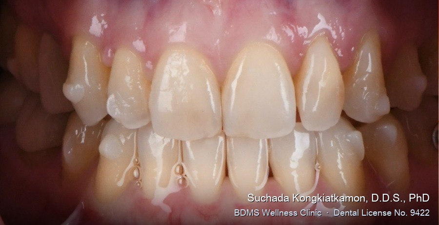Case 17 before