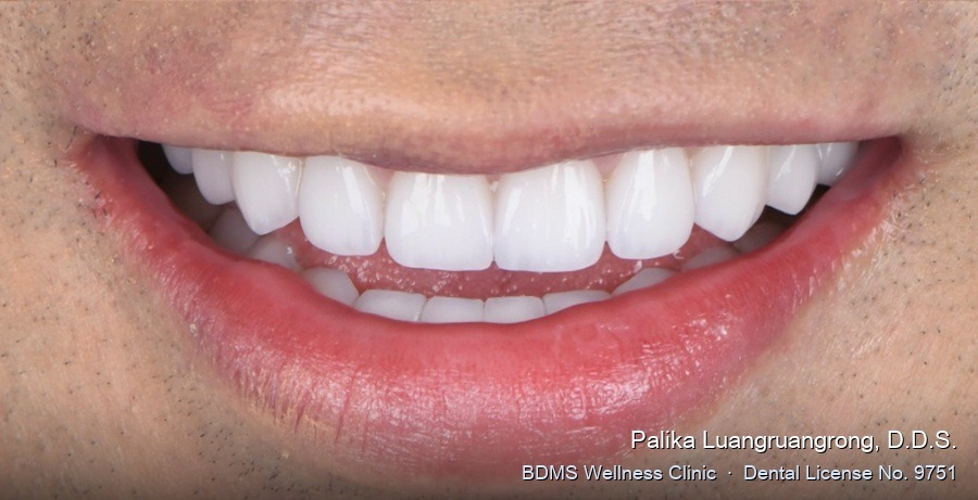 Case 22 after