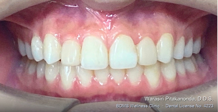 Case 01 after