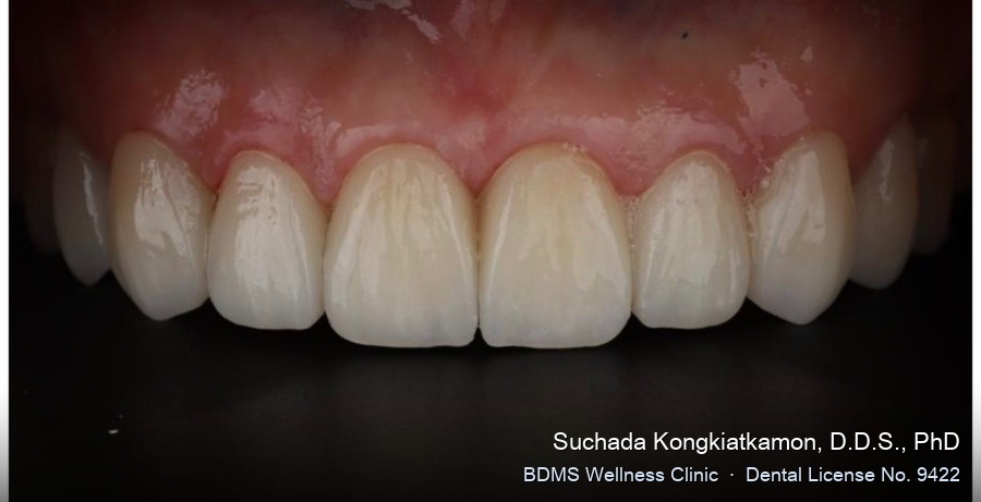 Case 11 after
