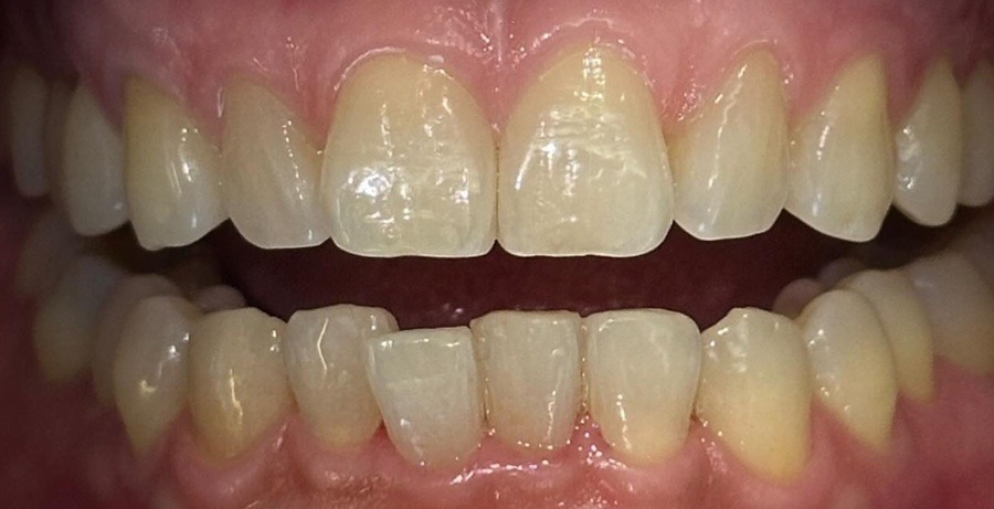 Case 31 before