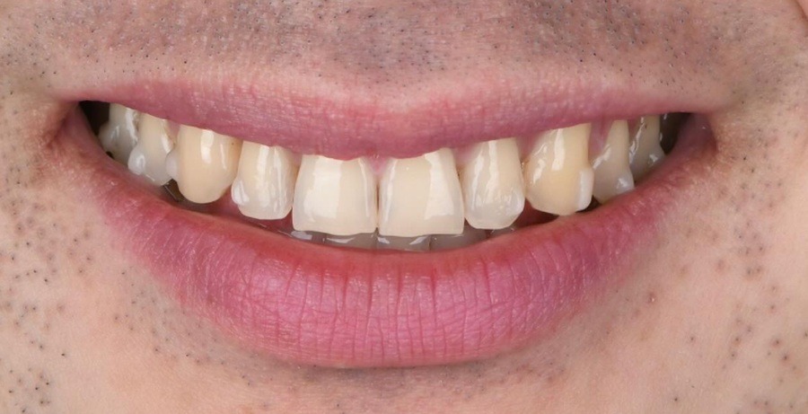Case 41 before