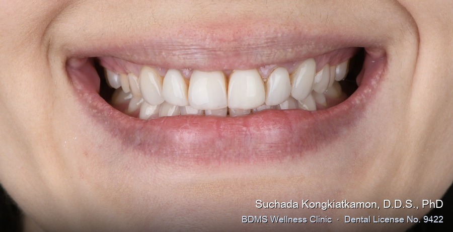 Case 12 before