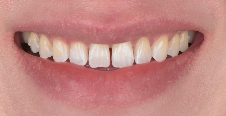 Case 30 before
