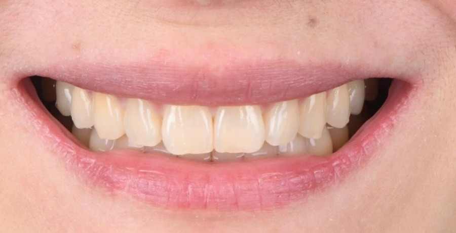 Case 32 before