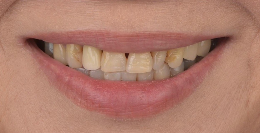 Case 35 before