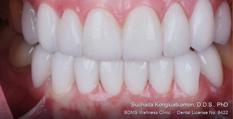 Case 17 after