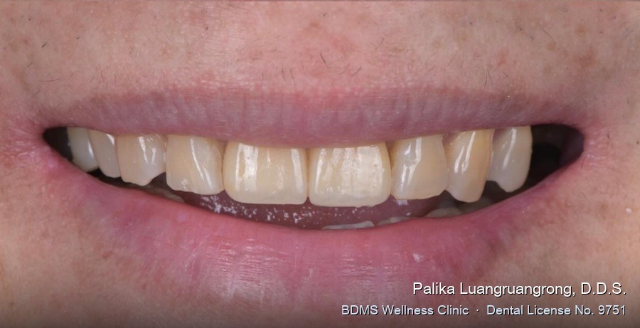 Case 29 after