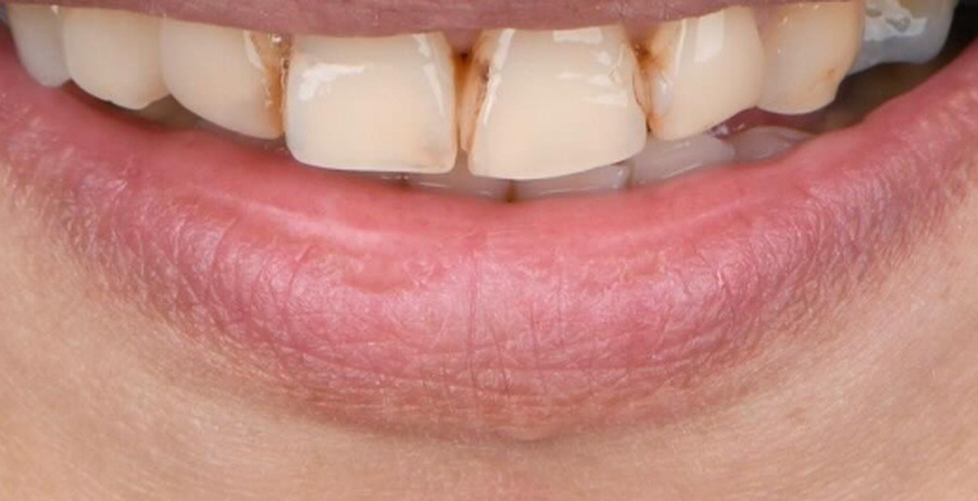 Case 42 before