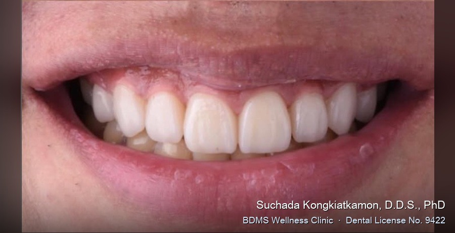 Case 03 after