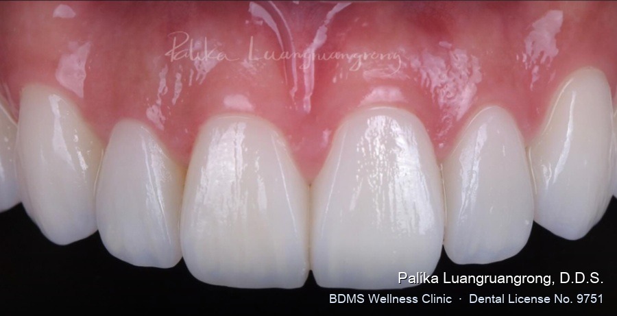 Case 40 after