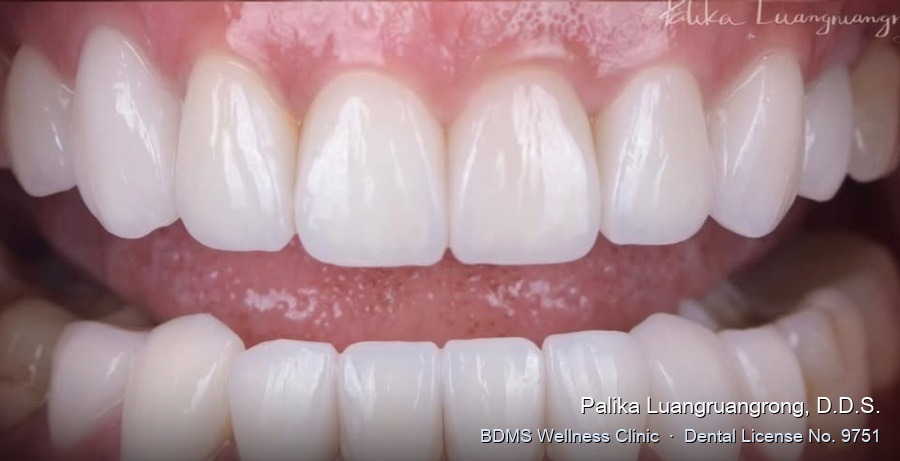 Case 25 after