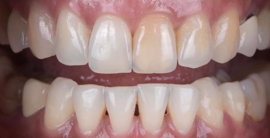 Case 25 before