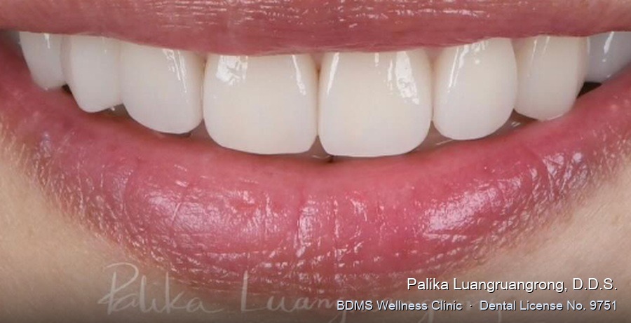 Case 42 after