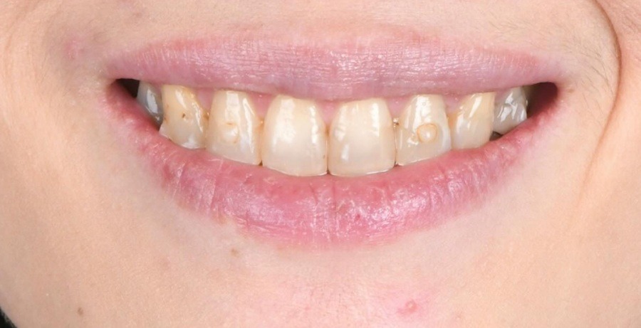 Case 38 before
