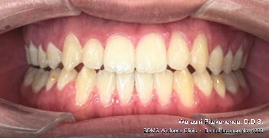 Case 03 after