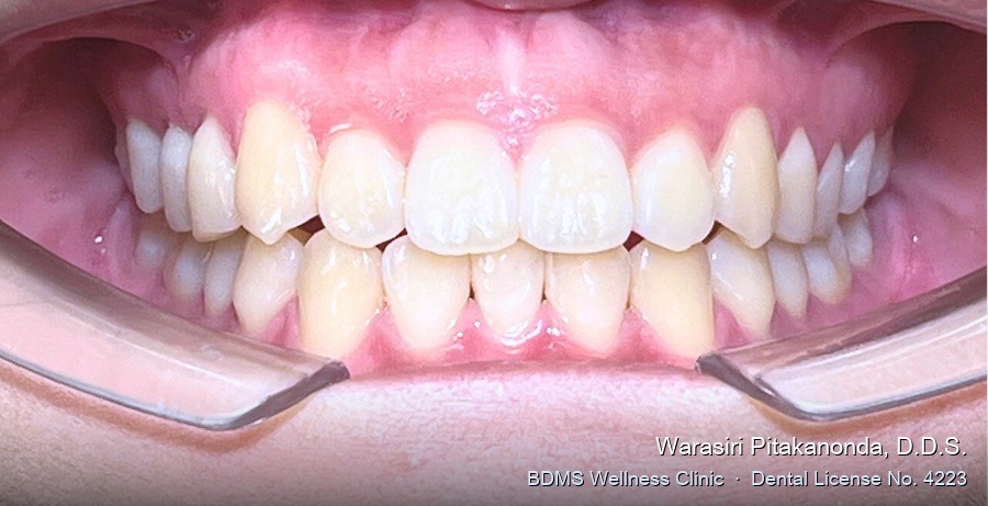 Case 06 after