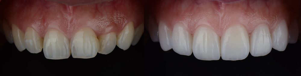 Before-and-after dental veneers, uneven yellow teeth beside even white teeth – BDMS Wellness Clinic