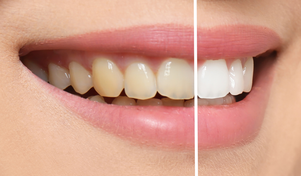Before-and-after teeth whitening comparison, yellowed teeth beside a bright white smile – BDMS Wellness Clinic