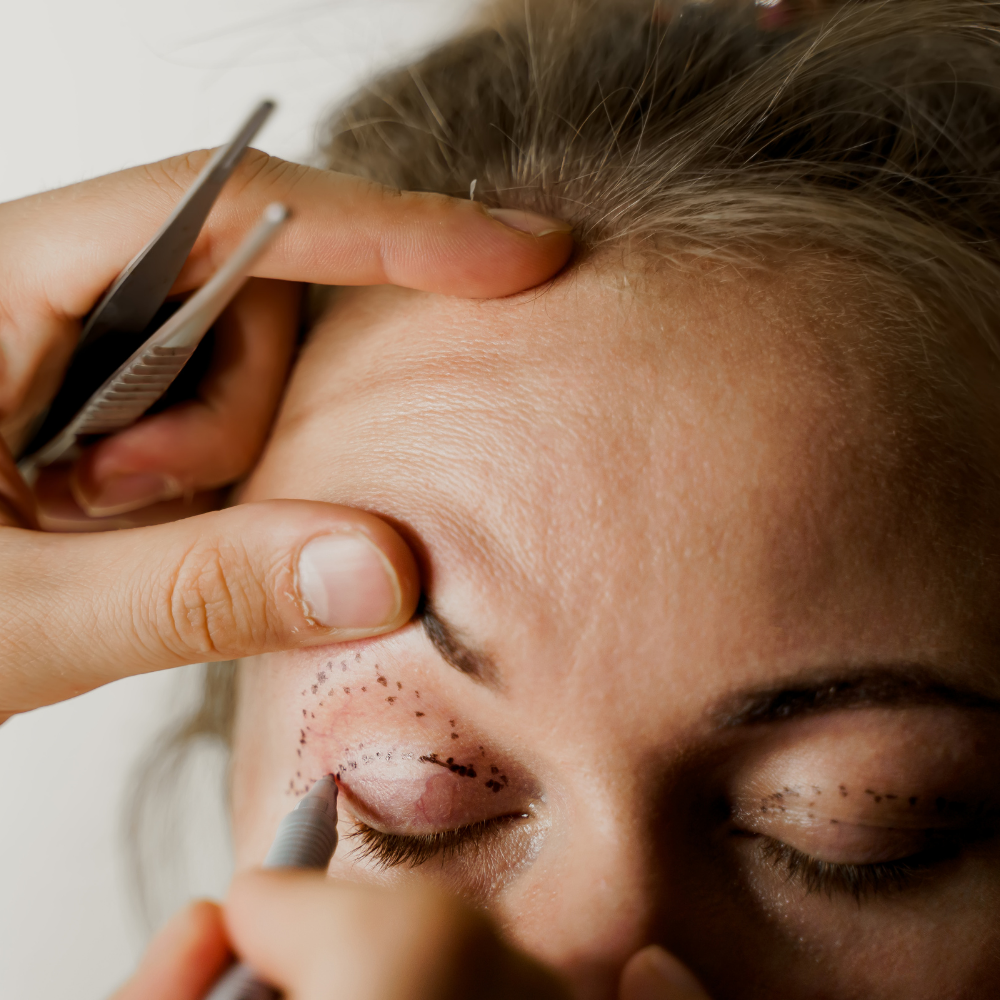 Blefaroplastia