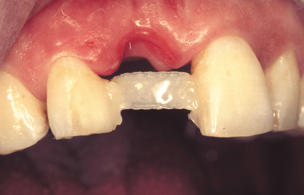 No universo da odontologia, a busca por materiais e técnicas que imitem as propriedades naturais dos dentes é constante. Esse é o princípio da abordagem biomimética, que visa restaurar e reforçar os dentes de maneira a replicar sua resistência, elasticidade e estética naturais.