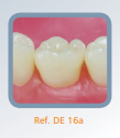 Dente 16 para Manequim de Dentística - DE 16