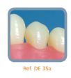 Dente 35 para Manequim de Dentística - DE 35